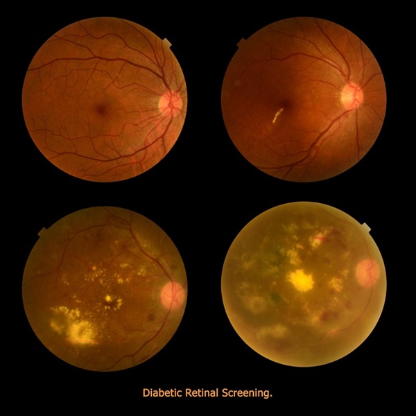 Complication of Diabetes